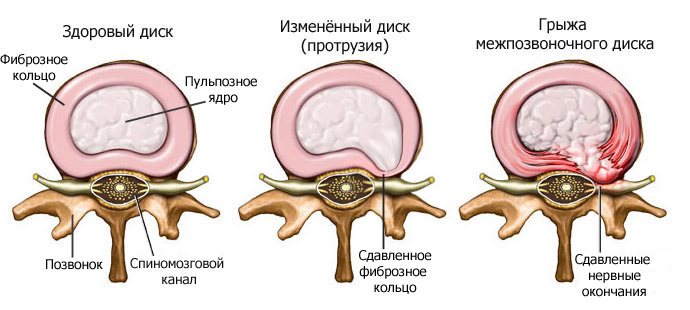 Доктор, у меня грыжа. Я умираю?