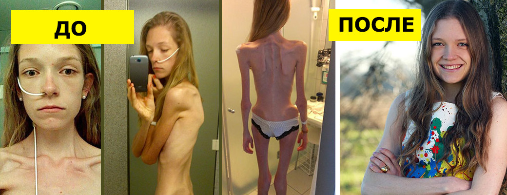 Анорексия: 30 фото ДО и ПОСЛЕ