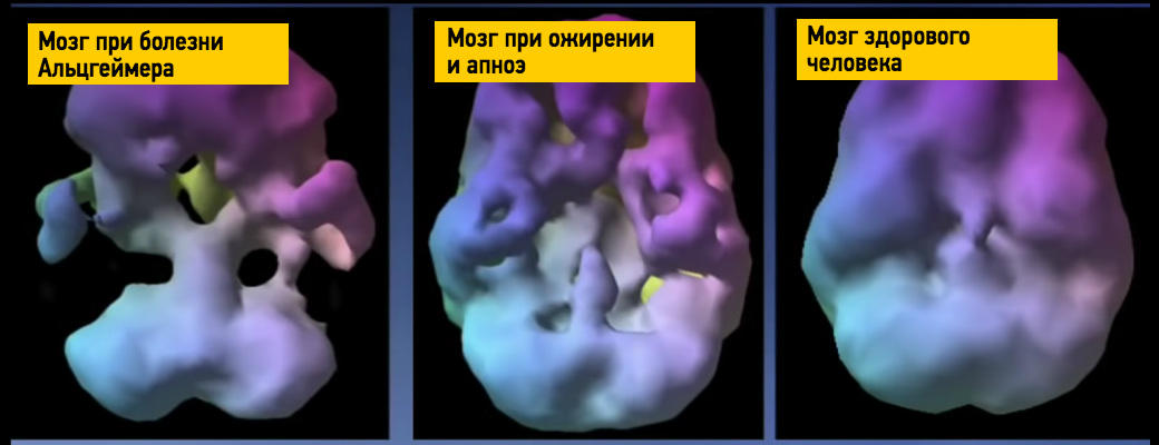 Как омолодить мозг в любом возрасте. Выступление нейробиолога