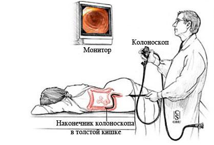 kolonoskopiya