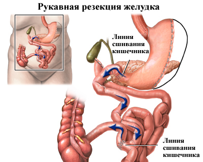 Лапароскопическая рукавная резекция желудка