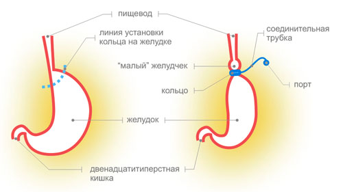 Лапароскопическое бандажирование желудка (желудочный баллон)