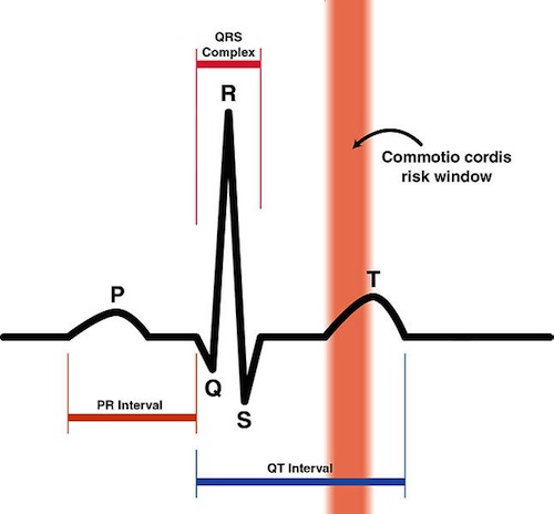 646px-Commotio_Cordis_Risk_Zone