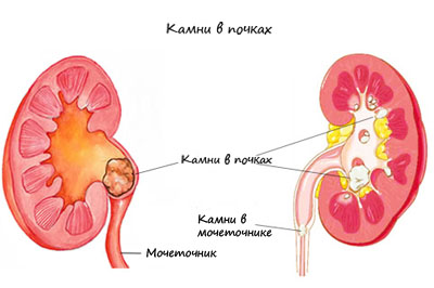 kamni_v_pochkah