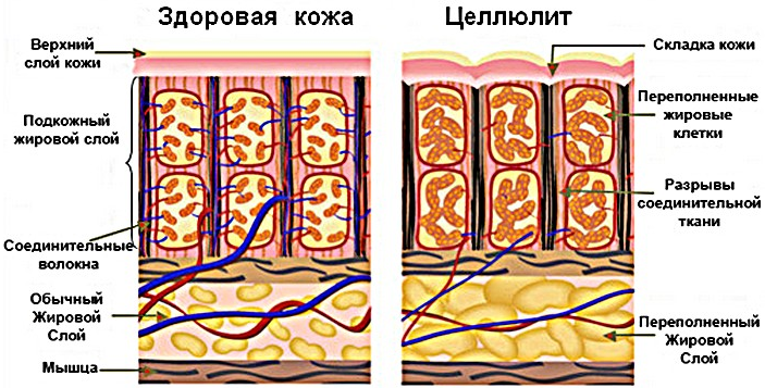 целлюлит
