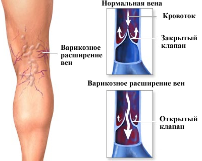 как получается варикоз 2