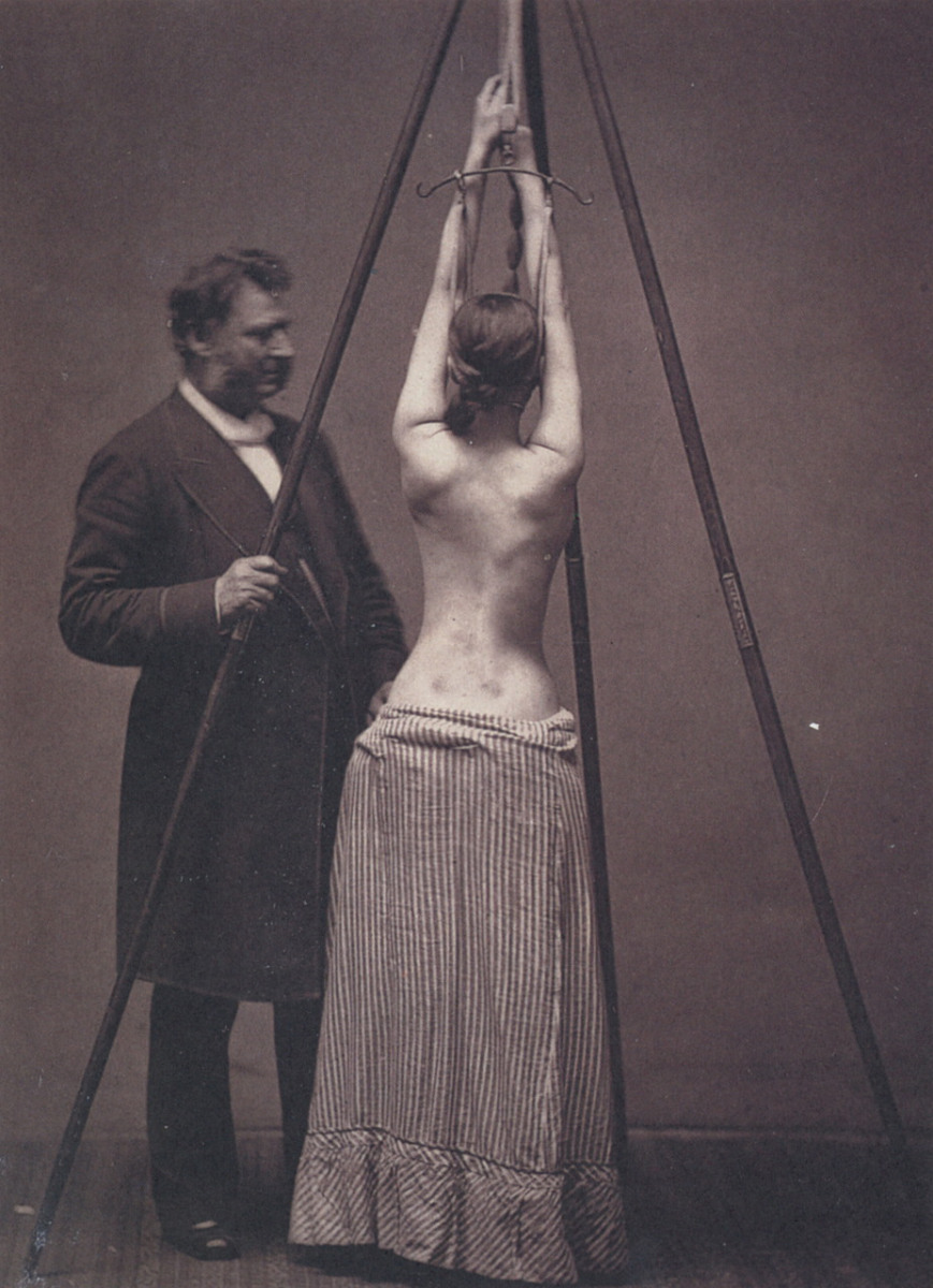 452 Лечение сколиоза, 1870–е, США