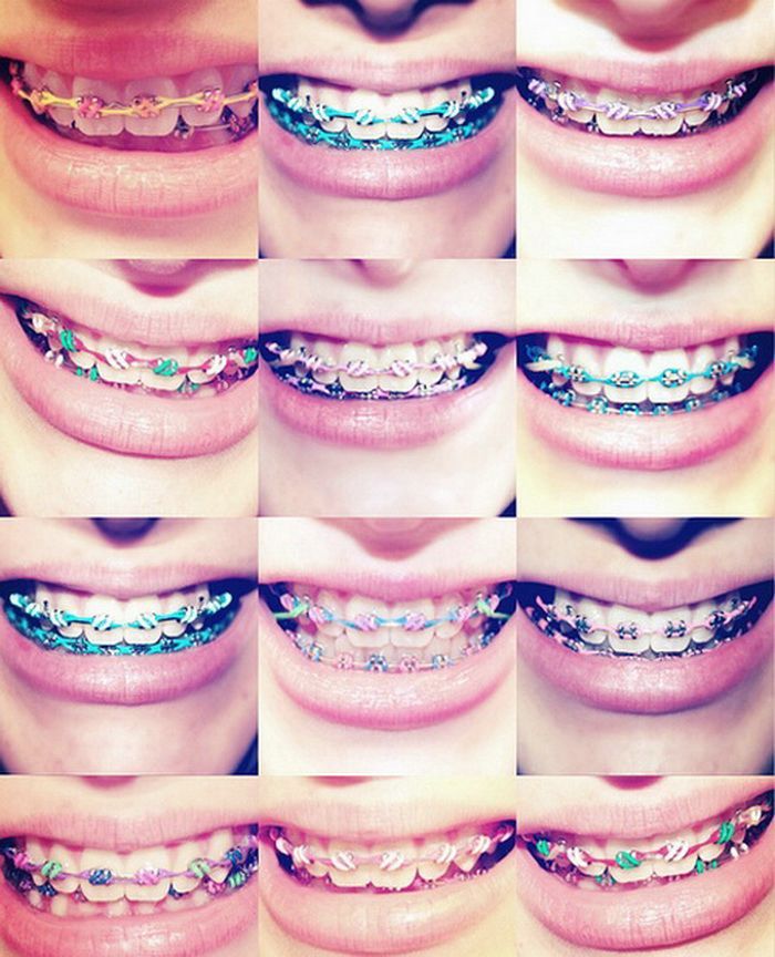 brace