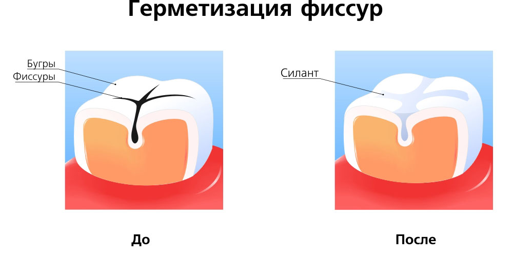 germetizaciya_fissur