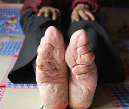 foot-binding-2