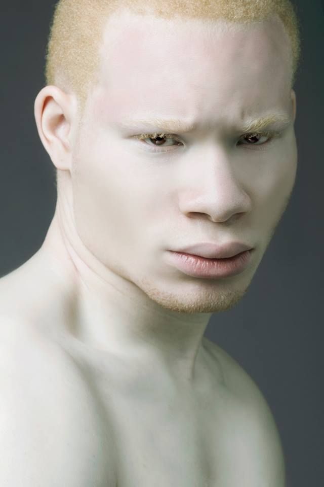 albino
